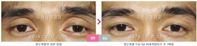 [두한성형외과 다크서클] - [다크서클 전후사진 검증] 관련 이미지 180