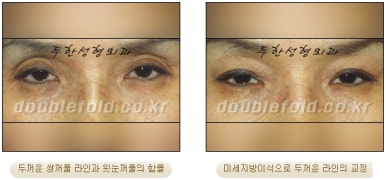 [두한성형외과 쌍커풀수술] - [쌍꺼풀지방이식] 관련 이미지 18