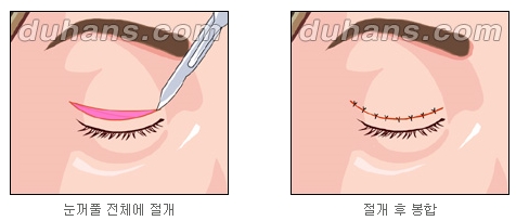 [두한성형외과 쌍커풀수술] - [눈성형 방법에 대한 자주하는 질문과 답변] 관련 이미지 2