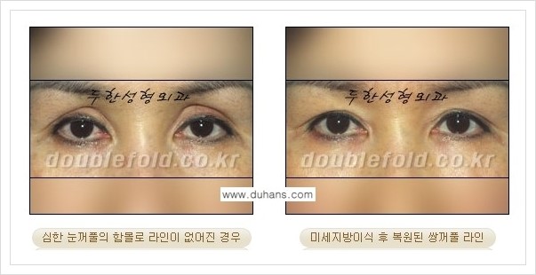 [두한성형외과 경쟁력 쌍꺼풀 재수술, 극한 재수술] - [미세지방이식으로 풀린 쌍꺼풀 교정] 관련 이미지 3