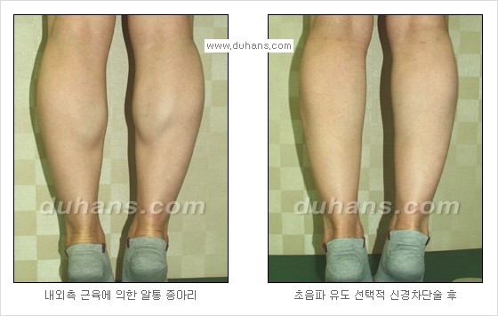 [두한성형외과 경쟁력 멀티종아리성형] - [종아리 퇴축수술 방법들의 문제점] 관련 이미지 11