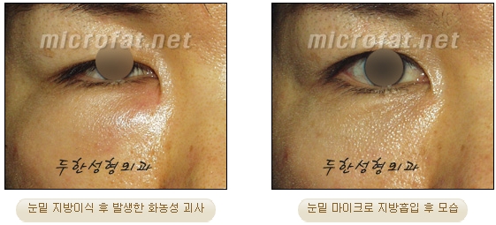 [Duhan Plastic Surgery Liposuction] - [Facial Liposuction] image 25