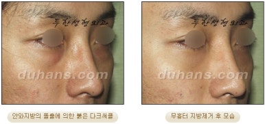 [두한성형외과 지방제거] - [눈두덩이지방제거, 눈밑지방제거] 관련 이미지 42