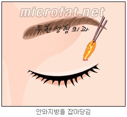 [두한성형외과 지방제거] - [눈밑지방제거, 윗눈꺼풀지방제거] 관련 이미지 56