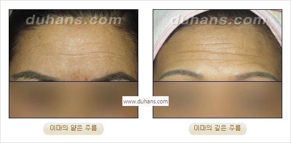 [두한성형외과 경쟁력 주름성형] - [간단하면서 자연스러운 주름제거 방법] 관련 이미지 7