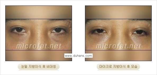 [두한성형외과 경쟁력 미세지방이식] - [미세지방이식 부작용 교정] 관련 이미지 6