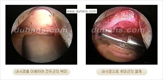 [두한성형외과 경쟁력 동안성형 리더] - ​[미간주름, 이마주름, 안검성형, 이마거상술, 눈썹거상술] 관련 이미지 49