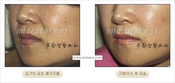 [두한성형외과 경쟁력 주름성형] - [주름 교정을 위한 안전하고 효과적인 미세지방이식] 관련 이미지 11