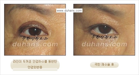 [두한성형외과 경쟁력 눈성형] - [두꺼운 라인을 교정하는 극한 눈 재수술 1.] 관련 이미지 11