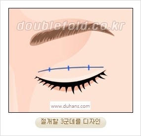 [두한성형외과 경쟁력 눈성형] - [자연스럽고 아름다운 눈매를 만드는 여러 가지 눈성형 방법] 관련 이미지 4