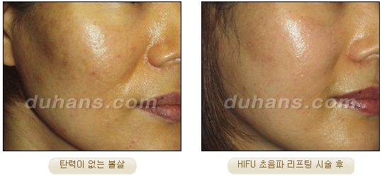 두한성형외과 주름개선 - 주름 HIFU 리프팅 관련 이미지 25