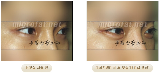 ​[두한성형외과 지방이식] - [애교살] 관련 이미지 20