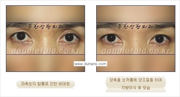 [두한성형외과 경쟁력 쌍꺼풀 재수술] - [쌍꺼풀 재수술 과정] 관련 이미지 102