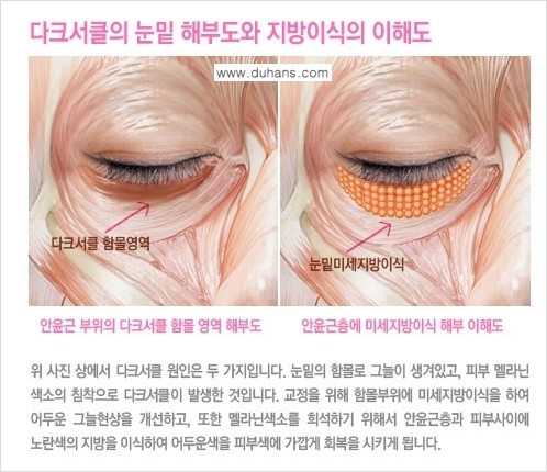 [두한성형외과 FOCUS 눈밑성형] - [다크써클의 치료방법 -  콜펫(Col-fat) 눈밑 미세지방이식 ④] 관련 이미지 5