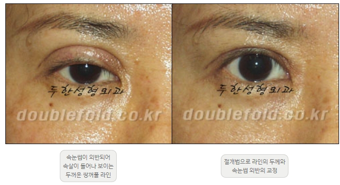 [Double Eyelid Surgery Duhan Plastic Surgery] - [Revision Methods] image 36