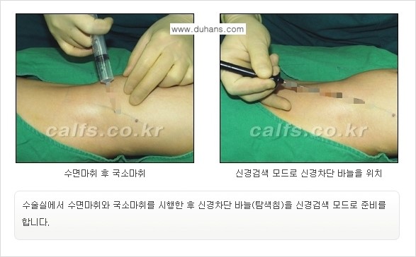 [두한성형외과 경쟁력 종아리성형] - [초음파 유도 선택적 신경차단술 안내 ②] 관련 이미지 7