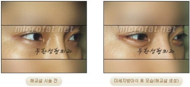 두한성형외과 눈밑성형 - 애교필러 후 눈밑재수술 관련 이미지 28