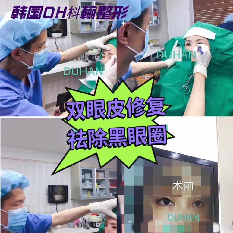 눈위 지방이식 후 쌍꺼풀재수술 만족후기!! 관련 이미지 2