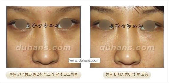 [두한성형외과 상큼하고 환한 눈매완성] - [눈밑 미세지방이식 ①] 관련 이미지 10