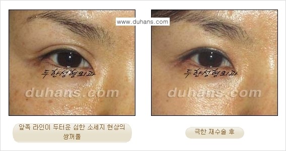 [두한성형외과 경쟁력 눈성형] - [두꺼운 라인을 교정하는 극한 눈 재수술 1.] 관련 이미지 5