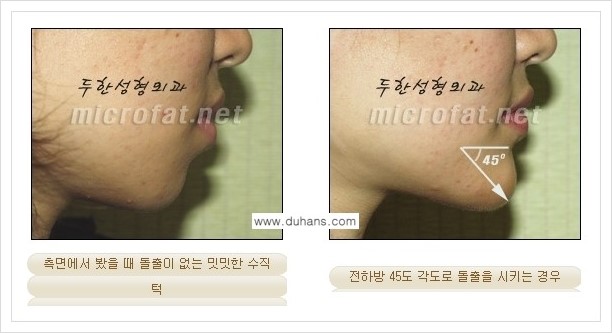 [두한성형외과의 경쟁력 미세지방이식] - [무턱교정, 턱 미세지방이식 안내 1.] 관련 이미지 6