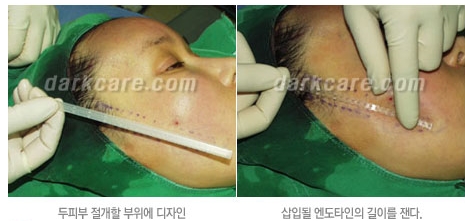 Duhan Plastic Surgery Combo Program - Dark Circles and Lifting image 10
