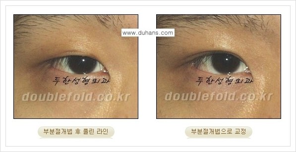 [두한성형외과 경쟁력 눈성형] - [풀린 쌍꺼풀 라인 재수술의 여러 가지 방법 안내] 관련 이미지 9
