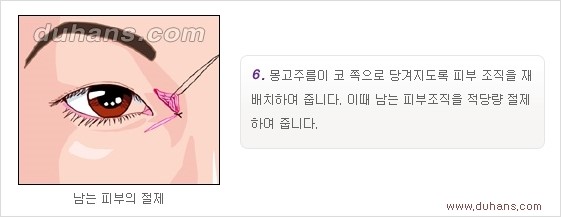 [두한성형외과 경쟁력 눈성형] - [흉터없는 몽고주름 제거 - 앞트임 수술 안내] 관련 이미지 14