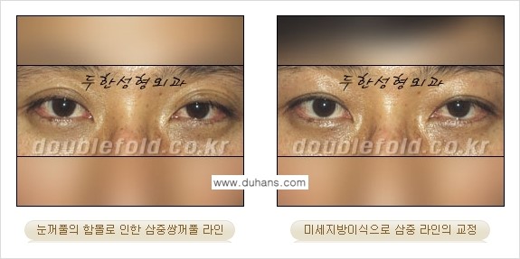 [두한성형외과 경쟁력 눈성형] - [삼중(세겹) 쌍꺼풀 라인의 교정] 관련 이미지 20