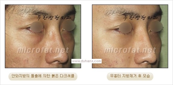 ⁠⁠[두한성형외과 경쟁력 안검성형] - [젊은 눈매를 위한 윗눈꺼풀 지방제거, 눈밑 지방제거] 관련 이미지 20