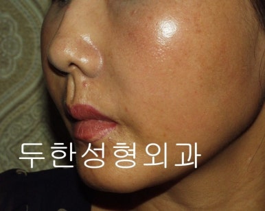[두한성형외과 얼굴지방이식] - [미간주름] 관련 이미지 27