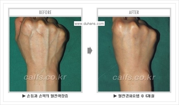 ⁠⁠[두한성형외과 정맥류 치료] - [손, 팔 정맥확장증 사진자료 안내 ②] 관련 이미지 7