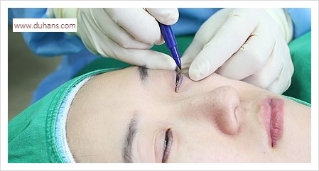 [두한성형외과 경쟁력 눈밑성형] - [눈밑애교살 시술을 위한 미세지방이식] 관련 이미지 4