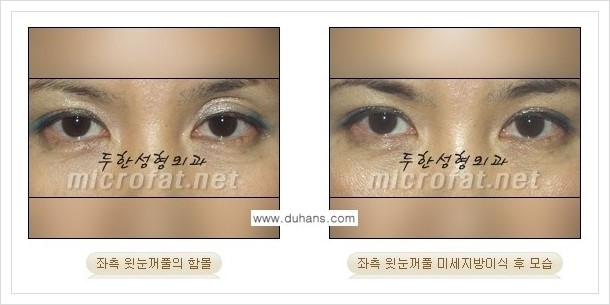 [두한성형외과의 경쟁력 미세지방이식] - [꺼진 눈꺼풀(윗눈꺼풀 함몰) 미세지방이식 안내] 관련 이미지 7