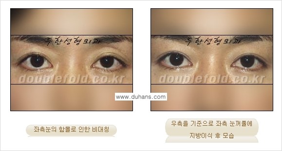 [두한성형외과 NO.1 눈성형] - [함몰된(꺼진) 눈꺼풀에서 쌍꺼풀 라인 교정 3.] 관련 이미지 4