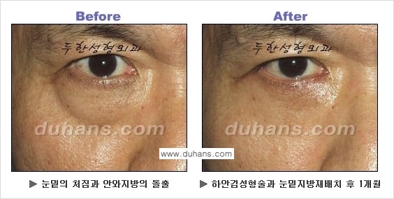 [두한성형외과의 상큼하고 환한 젊은 눈매완성] - [하안검 성형술 ①] 관련 이미지 6