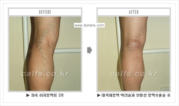 [두한성형외과 경쟁력 정맥류 치료] - [하지정맥류 사진 자료 안내 1.] 관련 이미지 9