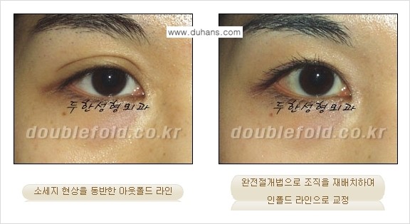 [두한성형외과 경쟁력 쌍꺼풀 재수술, 극한 눈재수술] - [심한 아웃폴드 라인을 인폴드 라인으로 교정 방법 안내] 관련 이미지 3