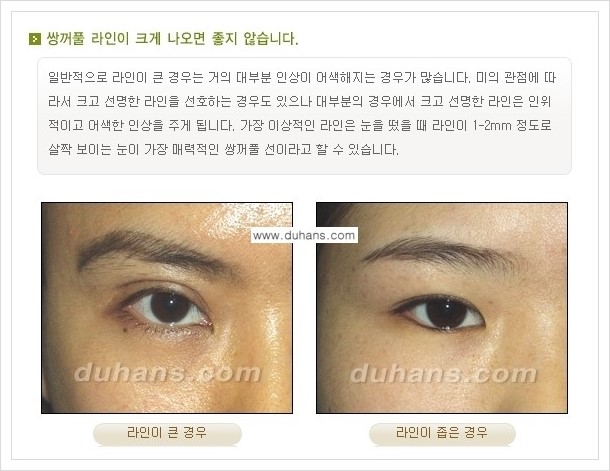 [두한성형외과 경쟁력 눈성형] - [아름다운 눈매를 쌍꺼풀수술 안내 ②] 관련 이미지 2