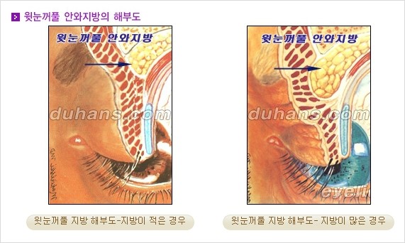 [두한성형외과 경쟁력 지방제거] - [눈꺼풀 지방제거, 눈밑 지방제거] 관련 이미지 2