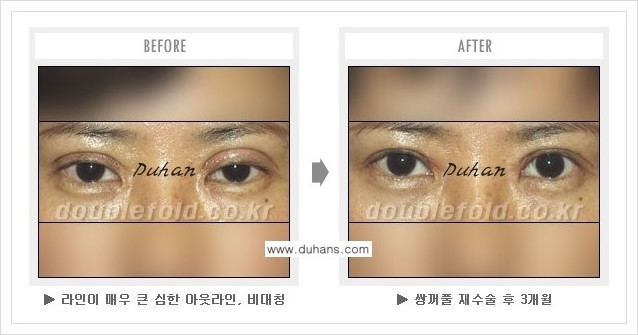 [두한성형외과 경쟁력 쌍꺼풀 재수술] - [여러번의 쌍꺼풀 재수술로 인한 흉살이 두터운 경우 안내] 관련 이미지 4