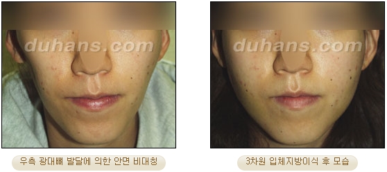 [두한성형외과 얼굴자가지방이식] - [볼살, 이마, 측두부] 관련 이미지 29