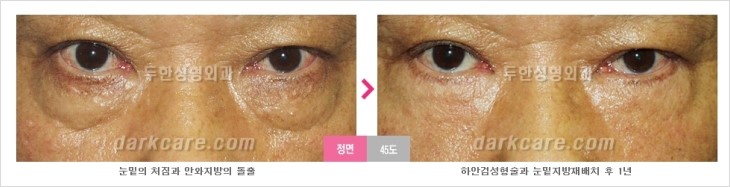 ​[두한성형외과 경쟁력 눈밑성형 리더] - [눈밑 다크써클의 증상, 원인, 종류, 치료방법 안내] 관련 이미지 53