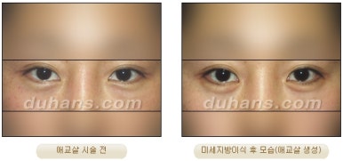 [두한성형외과 얼굴자가지방이식] - [눈밑 애교살 시술을 위한 미세지방이식] 관련 이미지 8