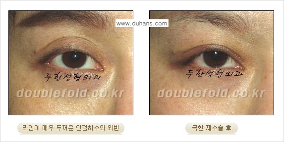 [두한성형외과 경쟁력 쌍꺼풀 재수술, 극한 눈재수술] - [망가진 쌍꺼풀 라인을 교정하는 극한 재수술을  위한 계획] 관련 이미지 4