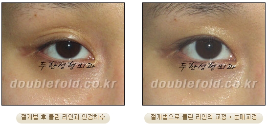 [Duhan Plastic Surgery Double Eyelid Revision Surgery] - [Ptosis Correction Surgery] image 54