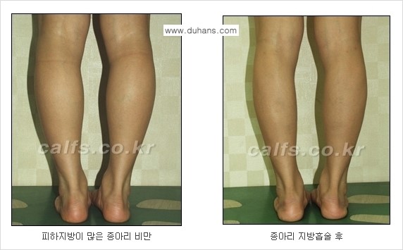 ⁠⁠[두한성형외과 경쟁력 멀티종아리성형] - [지방흡입이 필요한 종아리 비만 안내] 관련 이미지 8
