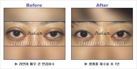 [두한성형외과 경쟁력 쌍꺼풀 재수술] - [안검하수 성형 흔한 질문과 답변 모음] 관련 이미지 5