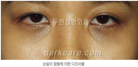 Duhan Plastic Surgery Dark Circle Improvement - What Causes Dark Circles? What Types of Dark Circles Are There? image 15