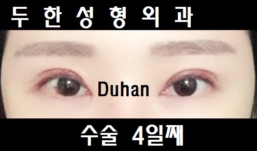 #아웃라인 #비대칭라인 에서 #인아웃라인 으로 #쌍꺼풀재수술 #다크써클 관련 이미지 2
